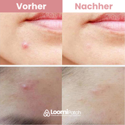 Loomi Mikropflaster | Pickelfrei über Nacht
