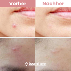 Loomi Mikropflaster | Pickelfrei über Nacht